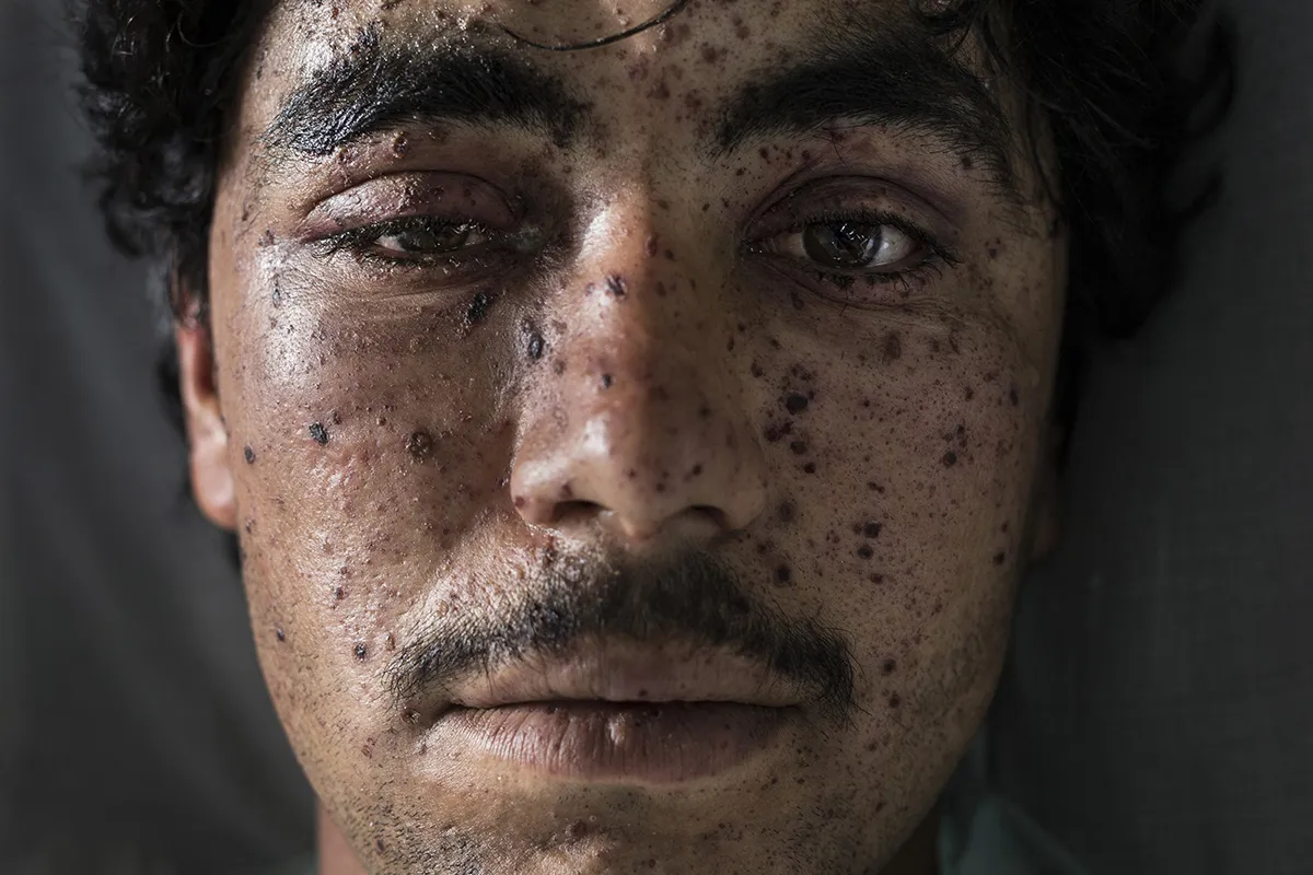 Paula Bronstein for The Cost of War | Recipient of the Getty Images Grant for Editorial Photography 2017