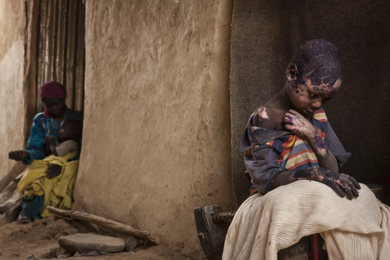 Contemporary Issues, second prize singles: Adam Abdel, 7, was severely burned after a bomb was dropped by a Sudanese government Antonov plane next to his family home in Burgu, Central Darfur, Sudan. Adriane Ohanesian.